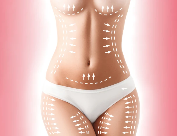 Cosmopolitan Aesthetics Hannover und Braunschweig - Der Plan zur Cellulite-Entfernung. Weiße Flecken auf dem Körper einer jungen Frau, die sich auf eine plastische Operation vorbereitet. Konzept zum Abnehmen, Fettabsaugung, Strähnenlifting